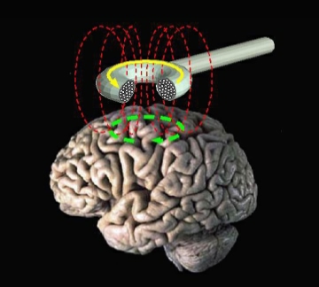 Transcranial_magnetic_stimulation Eric Wassermann, M.D. NIH Public domain